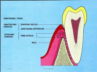 1/7/2018 Attached gingiva 7
 