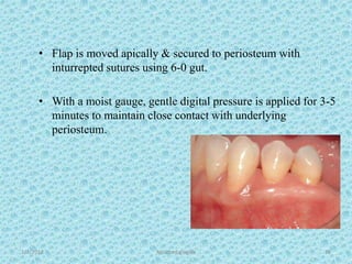 1/7/2018 Attached gingiva 78
• Flap is moved apically & secured to periosteum with
inturrepted sutures using 6-0 gut.
• With a moist gauge, gentle digital pressure is applied for 3-5
minutes to maintain close contact with underlying
periosteum.
 