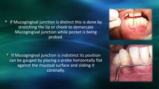 If Mucogingival junction is distinct this is done by
stretching the lip or cheek to demarcate
Mucogingival junction while pocket is being
probed.
If Mucogingival junction is indistinct its position
can be gauged by placing a probe horizontally flat
against the mucosal surface and sliding it
coronally.
 