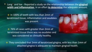 Lang* and loe - Reported a study on the relationship between the gingival
width and inflammation, in an effort to determine the adequate amount.
13. Lang, N.P. &Loe, H. 1972. The relationship between the width of keratinized Gingiva and gingival health./, Periodontol.43: 623-627.
 In 100% of teeth with less than 2mm of
keratinized tissue, inflammation and exudates
was present.
 76% of cases with greater than 2mm of
keratinized tissue there was no exudates and
was considered as clinically healthy.
 They concluded that 2mm of keratinized gingiva, with less than 1mm of
attached gingiva is adequate to maintain gingival health.
 
