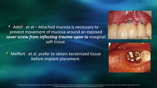 Adell* et al – Attached mucosa is necessary to
prevent movement of mucosa around an exposed
cover screw from inflecting trauma upon to marginal
soft tissue.
Meffert* et al. prefer to obtain keratinized tissue
before implant placement.
20. AdellR, LekholmU, RocklerB, Branemark P-I, Lindhe J, Eriksson B, Sbordone L. Marginal tissue recession at osseointegrated titanium fixture (I).A 3-year longitudinal prospective study. Int J oral maxillofacial surgery.1986; 15: 53-61.
21. Meffert RM, Langer B, Fritz ME: Dental implant: a review, J Periodontol.1992; 63: 859-870.
 