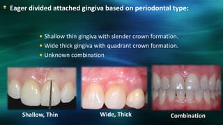 Eager divided attached gingiva based on periodontal type:
 Shallow thin gingiva with slender crown formation.
 Wide thick gingiva with quadrant crown formation.
 Unknown combination
Shallow, Thin Wide, Thick Combination
 