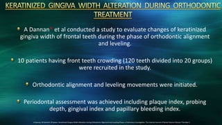 A Dannan* et al conducted a study to evaluate changes of keratinized
gingiva width of frontal teeth during the phase of orthodontic alignment
and leveling.
10 patients having front teeth crowding (120 teeth divided into 20 groups)
were recruited in the study.
Orthodontic alignment and leveling movements were initiated.
Periodontal assessment was achieved including plaque index, probing
depth, gingival index and papillary bleeding index.
*A Dannan, M Darwish, M Sawan. Keratinized Gingiva Width Alteration during Orthodontic Alignment and Leveling Phase; a Preliminary Investigation. The Internet Journal of Dental Science Volume 7 Number 2
 