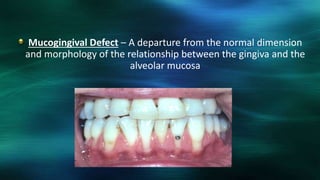 Mucogingival Defect – A departure from the normal dimension
and morphology of the relationship between the gingiva and the
alveolar mucosa
 