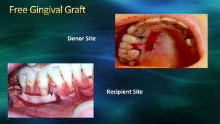 Recipient Site
Donor Site
 