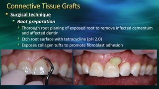 Surgical technique
Root preparation
Thorough root planing of exposed root to remove infected cementum
and affected dentin
Etch root surface with tetracycline (pH 2.0)
Exposes collagen tufts to promote fibroblast adhesion
 