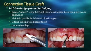 Incision design (tunnel technique)
Create “pouch” using full/split thickness incision between gingiva and
bone/root
Maintain papilla for bilateral blood supply
Extend incision to adjacent teeth
Undermine flap
 