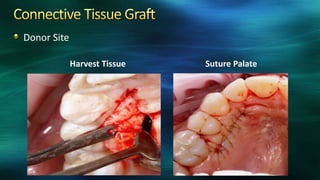 Donor Site
Harvest Tissue Suture Palate
 