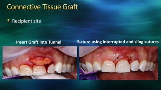 Recipient site
Insert Graft Into Tunnel Suture using interrupted and sling sutures
 