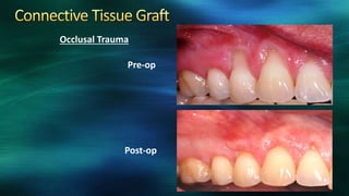 Pre-op
Post-op
Occlusal Trauma
 