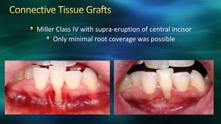 Miller Class IV with supra-eruption of central incisor
Only minimal root coverage was possible
 