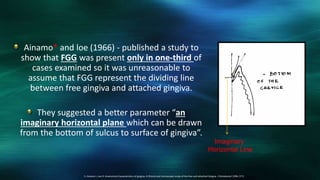 Ainamo* and loe (1966) - published a study to
show that FGG was present only in one-third of
cases examined so it was unreasonable to
assume that FGG represent the dividing line
between free gingiva and attached gingiva.
They suggested a better parameter “an
imaginary horizontal plane which can be drawn
from the bottom of sulcus to surface of gingiva”.
3. Ainamo J, Loe H: Anatomical characteristics of gingiva. A Clinical and microscopic study of the free and attached Gingiva. J Periodontol 1996; 37:5.
Imaginary
Horizontal Line
 