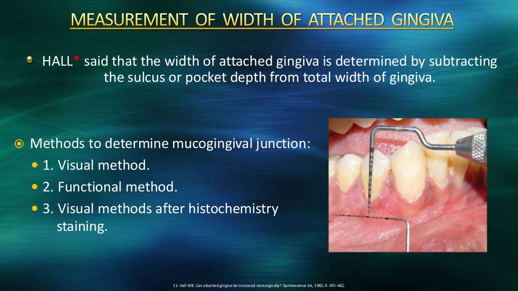 Attached gingiva and its significance