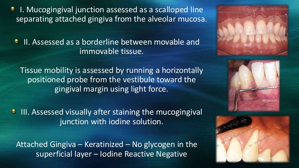 Attached gingiva and its significance