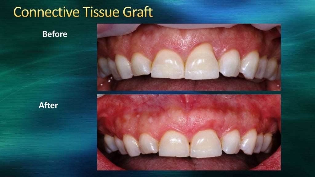 Attached gingiva and its significance