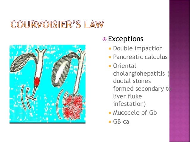 Obstructive jaundice Obstructive jaundice
