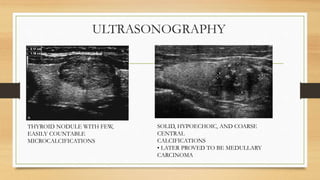 ULTRASONOGRAPHY
THYROID NODULE WITH FEW,
EASILY COUNTABLE
MICROCALCIFICATIONS
SOLID, HYPOECHOIC, AND COARSE
CENTRAL
CALCIFICATIONS
• LATER PROVED TO BE MEDULLARY
CARCINOMA
 