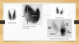 Thyroid Scan showing
cold nodule
Thyroid scan showing hot nodule
 