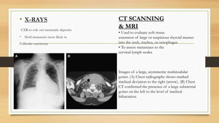 • X-RAYS
CXR to rule out metastatic deposits
• Skull metastasis more likely in
Follicular carcinoma
CT SCANNING
& MRI
• Used to evaluate soft-tissue
extension of large or suspicious thyroid masses
into the neck, trachea, or oesophagus
• To assess metastases to the
cervical lymph nodes
Images of a large, asymmetric multinodular
goiter. (A) Chest radiography shows marked
tracheal deviation to the right (arrow). (B) Chest
CT confirmed the presence of a large substernal
goiter on the left to the level of tracheal
bifurcation.
 