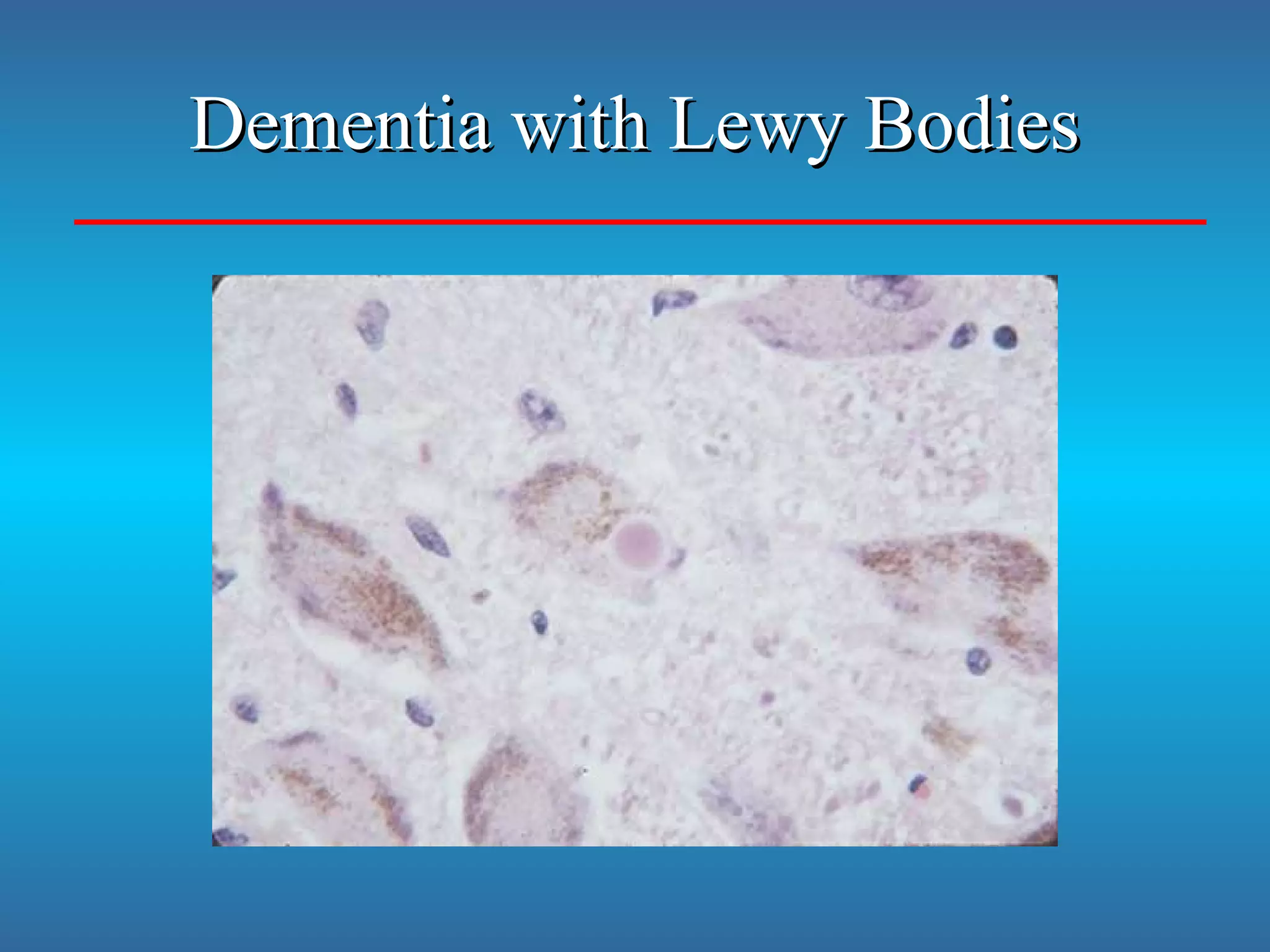 Dementia with Lewy BodiesDementia with Lewy Bodies
 