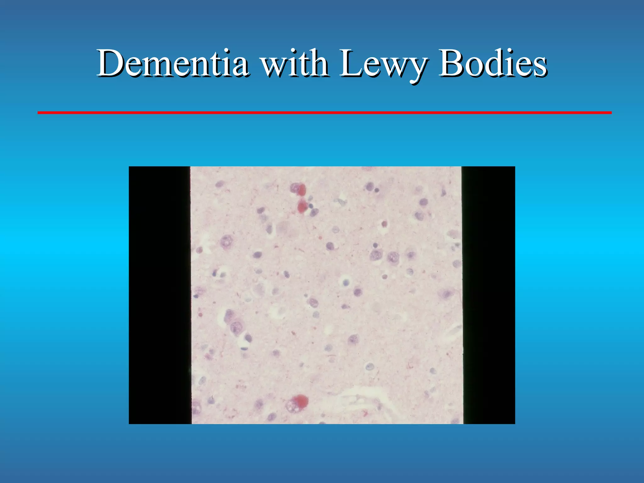 Dementia with Lewy BodiesDementia with Lewy Bodies
 
