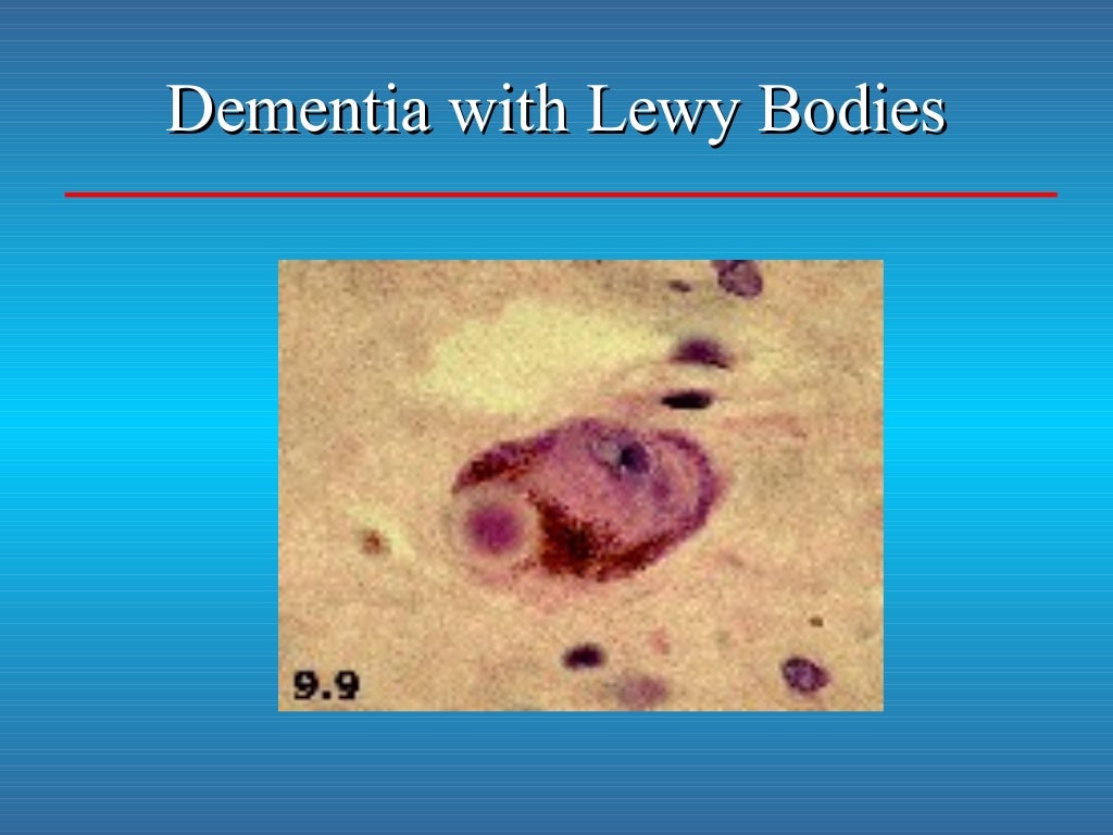 LEWY BODY DEMENTIA