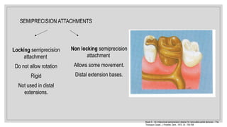 Locking semiprecision
attachment
Do not allow rotation
Rigid
Not used in distal
extensions.
Non locking semiprecision
attachment
Allows some movement.
Distal extension bases.
SEMIPRECISION ATTACHMENTS
Koper A. : An intracoronal semiprecision retainer for removable partial dentures – The
Thompson Dowel. J. Prosthet. Dent., 1973; 30 : 759-768
 