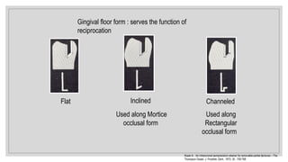 Flat Inclined Channeled
Used along Mortice
occlusal form
Used along
Rectangular
occlusal form
Gingival floor form : serves the function of
reciprocation
Koper A. : An intracoronal semiprecision retainer for removable partial dentures – The
Thompson Dowel. J. Prosthet. Dent., 1973; 30 : 759-768
 