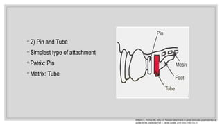 ◦ 2) Pin and Tube
◦ Simplest type of attachment
◦ Patrix: Pin
◦ Matrix: Tube
Williams G, Thomas MB, Addy LD. Precision attachments in partial removable prosthodontics: an
update for the practitioner Part 1. Dental Update. 2014 Oct 2;41(8):725-31.
 