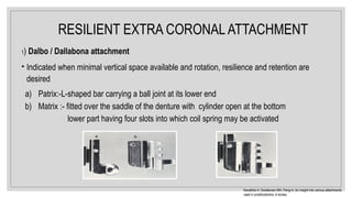 RESILIENT EXTRA CORONAL ATTACHMENT
1) Dalbo / Dallabona attachment
• Indicated when minimal vertical space available and rotation, resilience and retention are
desired
a) Patrix:-L-shaped bar carrying a ball joint at its lower end
b) Matrix :- fitted over the saddle of the denture with cylinder open at the bottom
lower part having four slots into which coil spring may be activated
Kanathila H, Doddamani MH, Pangi A. An insight into various attachments
used in prosthodontics: A review.
 