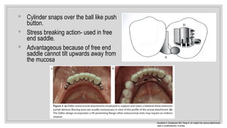 ◦ Cylinder snaps over the ball like push
button.
◦ Stress breaking action- used in free
end saddle.
◦ Advantageous because of free end
saddle cannot tilt upwards away from
the mucosa
Kanathila H, Doddamani MH, Pangi A. An insight into various attachments
used in prosthodontics: A review.
 