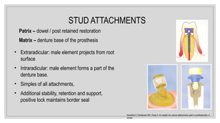 STUD ATTACHMENTS
Patrix – dowel / post retained restoration
Matrix – denture base of the prosthesis
• Extraradicular: male element projects from root
surface
• Intraradicular: male element forms a part of the
denture base.
• Simples of all attachments,
• Additional stability, retention and support,
positive lock maintains border seal
Kanathila H, Doddamani MH, Pangi A. An insight into various attachments used in prosthodontics: A
review.
 