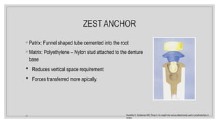 ZEST ANCHOR
◦ Patrix: Funnel shaped tube cemented into the root
◦ Matrix: Polyethylene – Nylon stud attached to the denture
base
 Reduces vertical space requirement
 Forces transferred more apically.
◦ Kanathila H, Doddamani MH, Pangi A. An insight into various attachments used in prosthodontics: A
review.
 