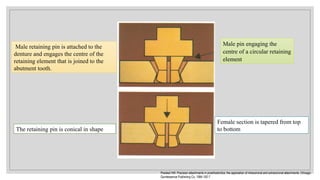 The retaining pin is conical in shape
Female section is tapered from top
to bottom
Male pin engaging the
centre of a circular retaining
element
Male retaining pin is attached to the
denture and engages the centre of the
retaining element that is joined to the
abutment tooth.
Preiskel HW. Precision attachments in prosthodontics: the application of intracoronal and extracoronal attachments. Chicago:
Quintessence Publishing Co, 1984:192-7
 
