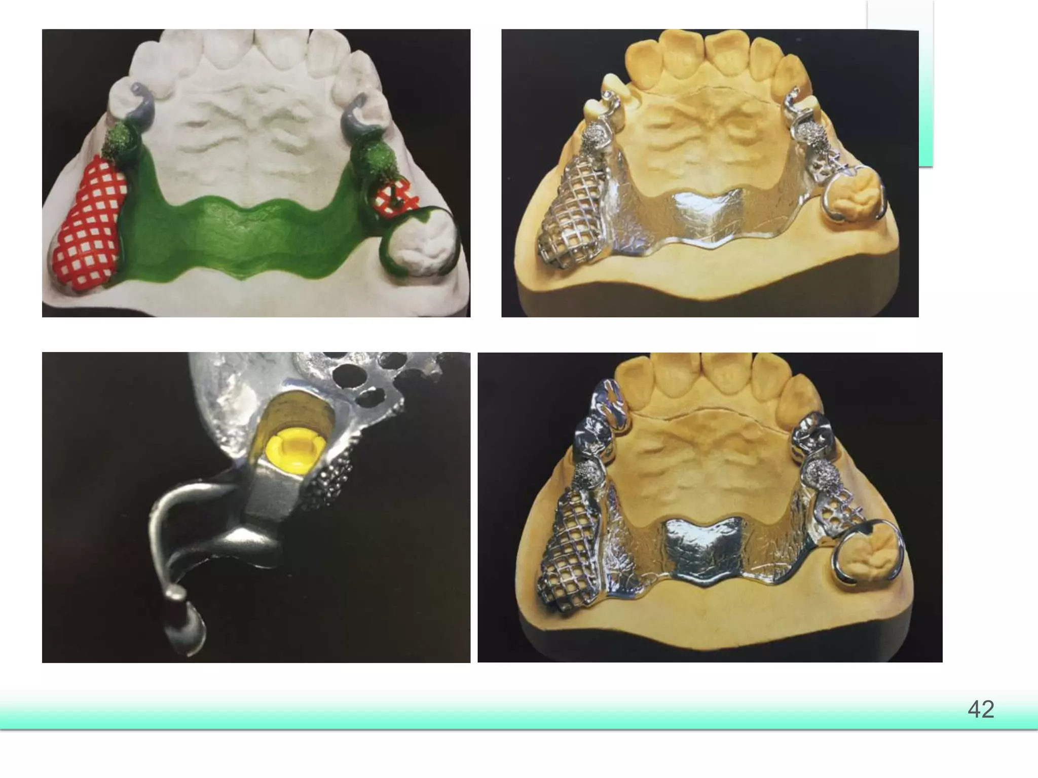 Attachments in removable partial prosthesis | PPTX
