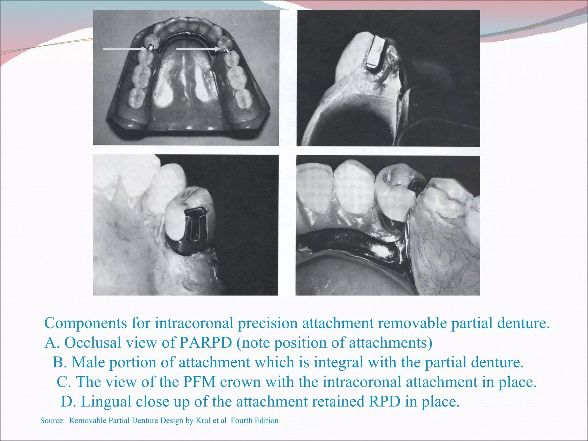 Internal Attachment In Rpd Attachments & their use in rpd fabrication | PPT