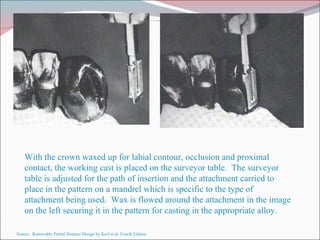 With the crown waxed up for labial contour, occlusion and proximal contact, the working cast is placed on the surveyor table.  The surveyor table is adjusted for the path of insertion and the attachment carried to place in the pattern on a mandrel which is specific to the type of attachment being used.  Wax is flowed around the attachment in the image on the left securing it in the pattern for casting in the appropriate alloy. Source:  Removable Partial Denture Design by Krol et al  Fourth Edition 