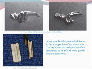 A lug must be fabricated which is cast to the male portion of the attachment.  The lug allows the male portion of the attachment to be affixed to the partial denture framework. Source:  Removable Partial Denture Design by Krol et al  Fourth Edition Source : Jeff Shotwell, University of Michigan, 2008 