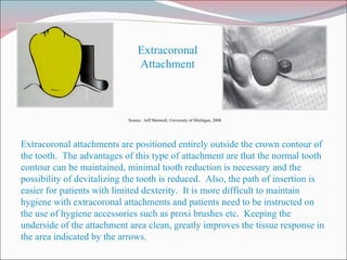 Extracoronal Attachment Extracoronal attachments are positioned entirely outside the crown contour of the tooth.  The advantages of this type of attachment are that the normal tooth contour can be maintained, minimal tooth reduction is necessary and the possibility of devitalizing the tooth is reduced.  Also, the path of insertion is easier for patients with limited dexterity.  It is more difficult to maintain hygiene with extracoronal attachments and patients need to be instructed on the use of hygiene accessories such as proxi brushes etc.  Keeping the underside of the attachment area clean, greatly improves the tissue response in the area indicated by the arrows. Source : Jeff Shotwell, University of Michigan, 2008 