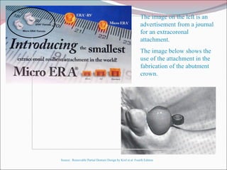 The image on the left is an advertisement from a journal for an extracoronal attachment. The image below shows the use of the attachment in the fabrication of the abutment crown. Source:  Removable Partial Denture Design by Krol et al  Fourth Edition 