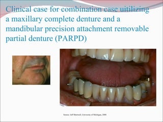 Clinical case for combination case uitilizing a maxillary complete denture and a mandibular precision attachment removable partial denture (PARPD) Source: Jeff Shotwell, University of Michigan, 2008 