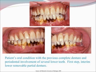 Patient’s oral condition with the previous complete denture and periodontal involvement of several lower teeth.  First step, interim lower removable partial denture. Source: Jeff Shotwell, University of Michigan, 2008 