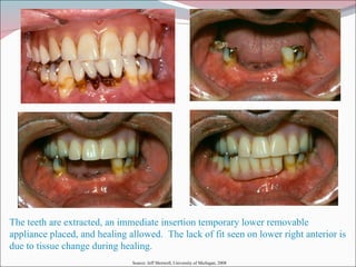 The teeth are extracted, an immediate insertion temporary lower removable appliance placed, and healing allowed.  The lack of fit seen on lower right anterior is due to tissue change during healing. Source: Jeff Shotwell, University of Michigan, 2008 
