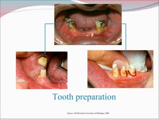 Tooth preparation Source: Jeff Shotwell, University of Michigan, 2008 
