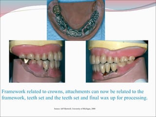 Framework related to crowns, attachments can now be related to the framework, teeth set and the teeth set and final wax up for processing. Source: Jeff Shotwell, University of Michigan, 2008 