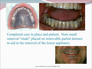 Completed case in place and patient.  Note small removal “studs” placed on removable partial denture to aid in the removal of the lower appliance. Source: Jeff Shotwell, University of Michigan, 2008 