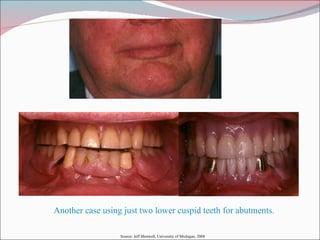 Another case using just two lower cuspid teeth for abutments. Source: Jeff Shotwell, University of Michigan, 2008 