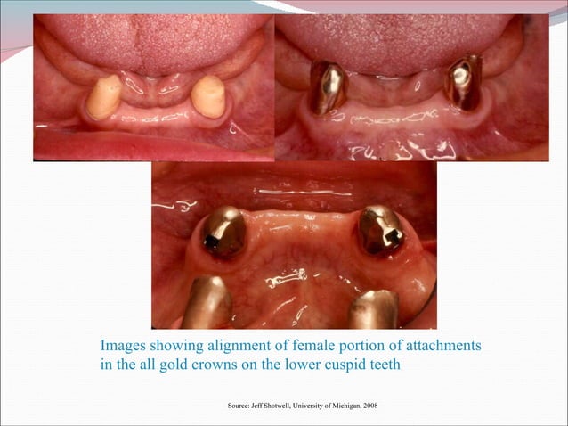 Internal Attachment In Rpd Attachments & their use in rpd fabrication | PPT