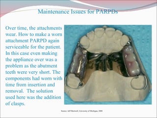 Over time, the attachments wear. How to make a worn attachment PARPD again serviceable for the patient.  In this case even making the appliance over was a problem as the abutment teeth were very short. The components had worn with time from insertion and removal.  The solution used here was the addition of clasps. Maintenance Issues for PARPDs Source: Jeff Shotwell, University of Michigan, 2008 