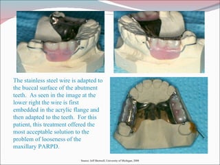 The stainless steel wire is adapted to the buccal surface of the abutment teeth.  As seen in the image at the lower right the wire is first embedded in the acrylic flange and then adapted to the teeth.  For this patient, this treatment offered the most acceptable solution to the problem of looseness of the maxillary PARPD. Source: Jeff Shotwell, University of Michigan, 2008 